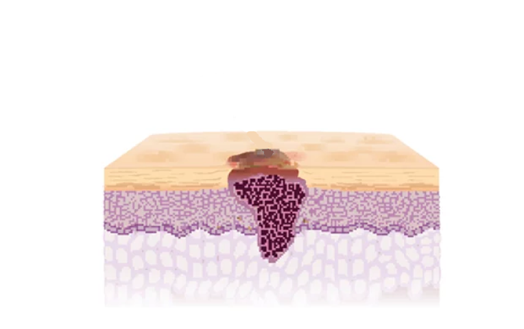 Bild des Aufbaus eines Basazellkarzinoms