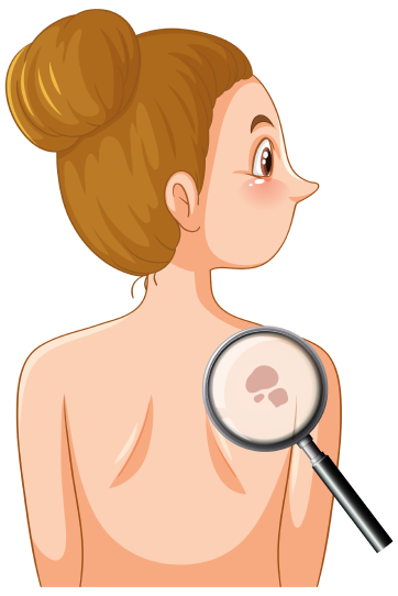 Haut gegen Hautkrebs kontrollieren